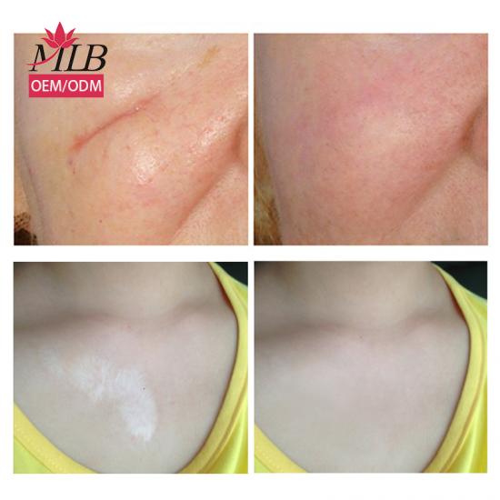 acne removal cream