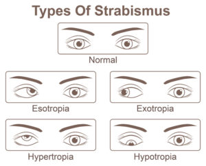 Sind Augenklappen gut für die Augen?
